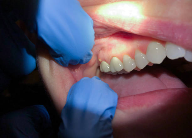 Best Emergency Treatment for Dental Infections or Abscesses in Valdese, NC